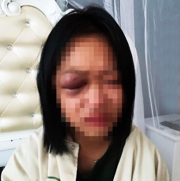 Vùng mắt em L. bị sưng phù khi bị nhóm thanh thiếu niên đánh bằng mũ bảo hiểm tối 23/10. Ảnh: Gia đình cung cấp