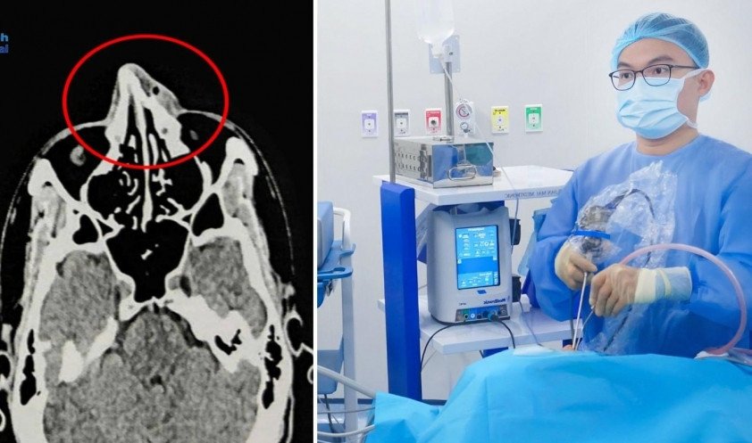 Bác sĩ khuyến cáo thăm khám sớm khi có sưng đau, chảy máu mũi