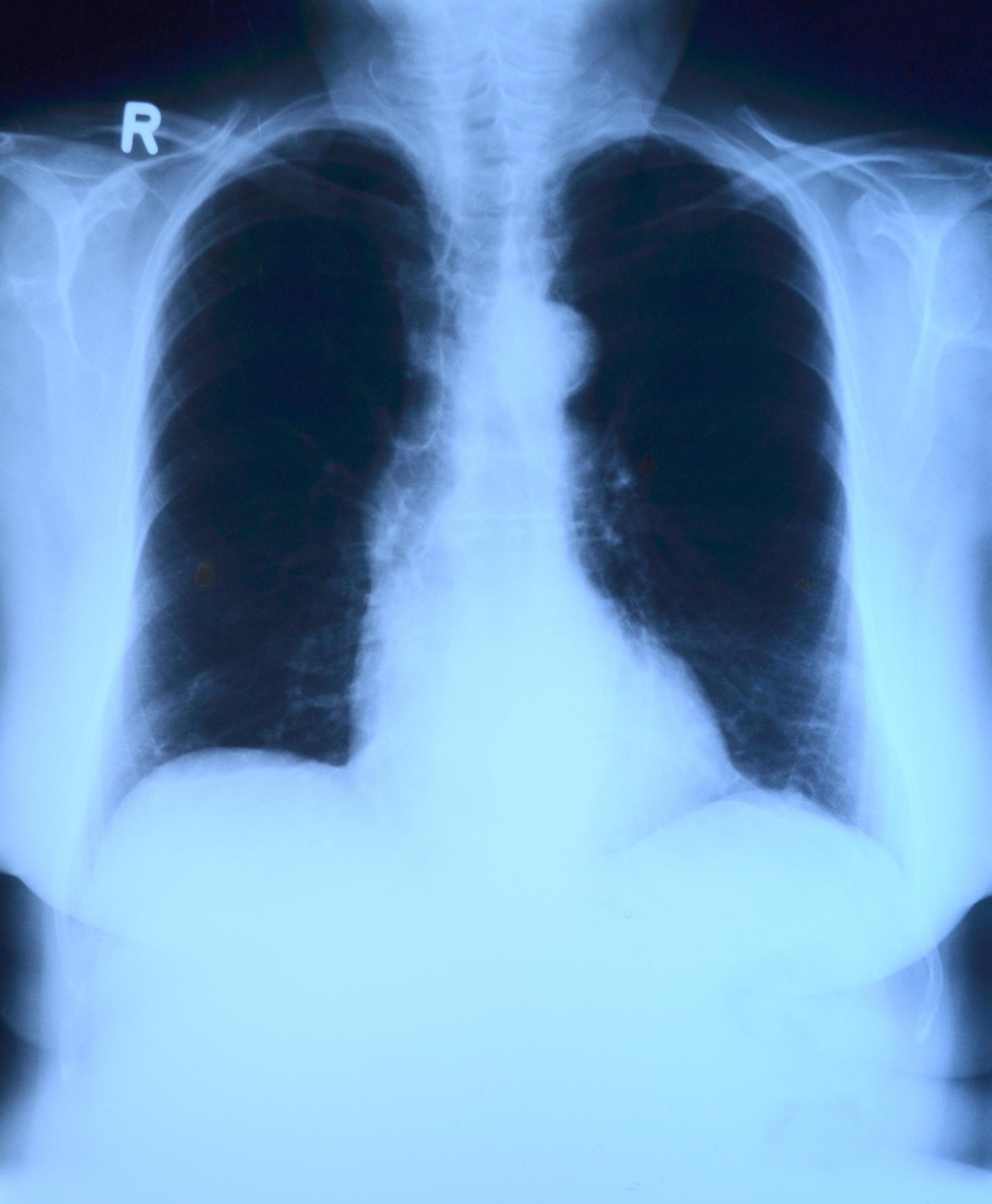 x-ray-image-568241_1920.jpg