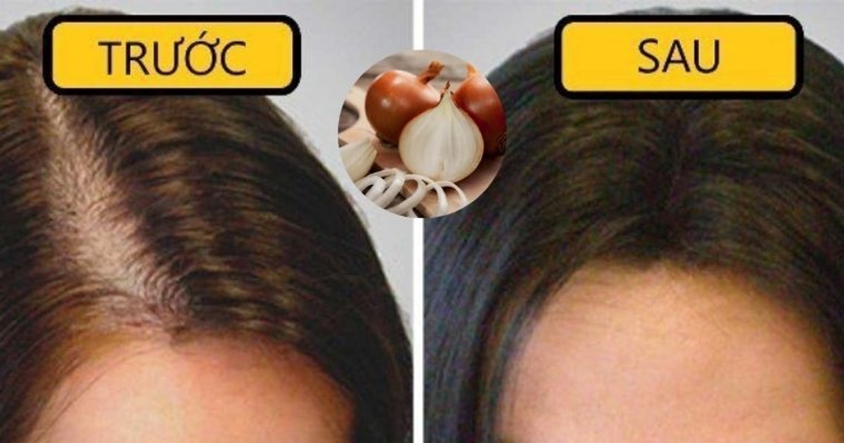 Bật mí 9 công thức kích thích tọc mọc nhanh, giảm hói chỉ với 1 củ hành...