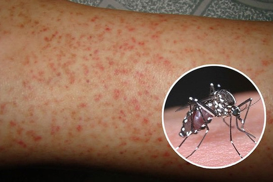 Sốt xuất huyết ở người lớn: Triệu chứng và cách điều trị