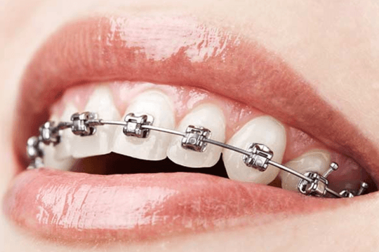 Phân biệt niềng răng mắc cài kim loại buộc chun và tự đóng