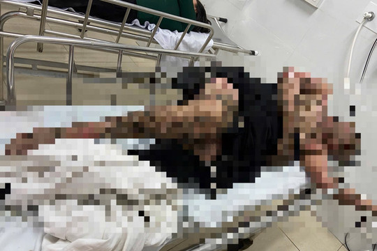 Bị bỏng nặng vì quăng dây câu cá trúng dây điện