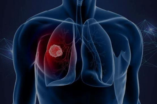 Phác đồ điều trị mới giúp tăng gấp đôi thời gian sống cho bệnh nhân ung thư phổi