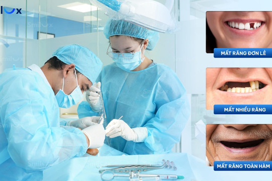 Hệ lụy âm thầm khi mất răng và giải pháp Implant