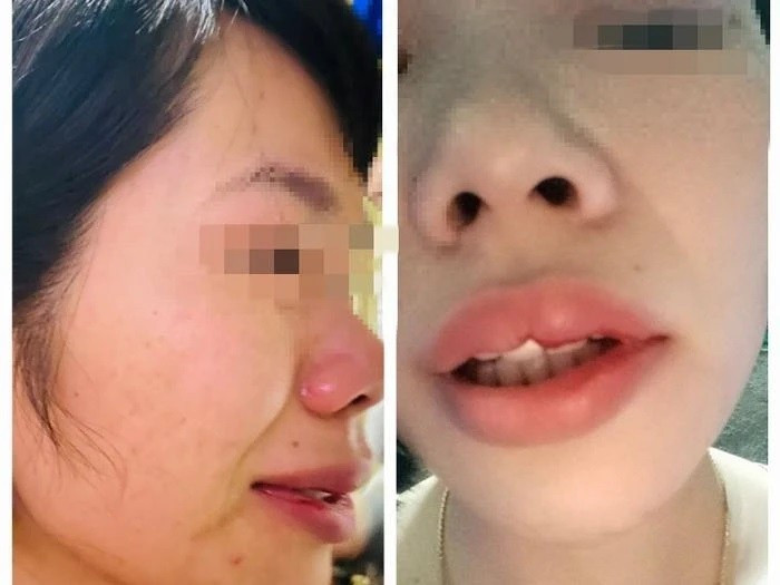 Vụ phụ huynh đánh cô giáo ở Đắk Nông: Xử phạt hành chính 6,5 triệu đồng