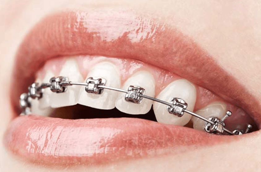 Phân biệt niềng răng mắc cài kim loại buộc chun và tự đóng