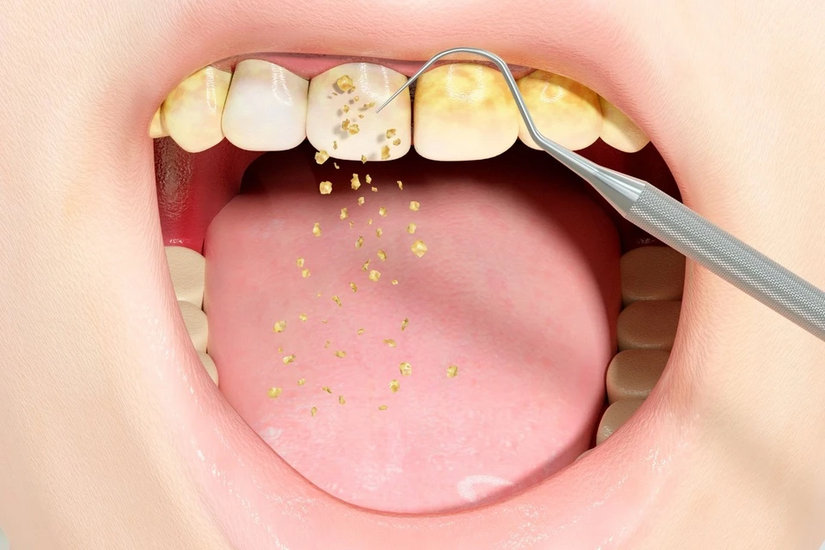 Tại sao cần lấy cao răng định kỳ và những dấu hiệu cảnh báo bạn không nên bỏ qua