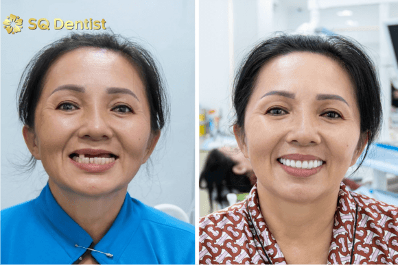 Mất Nhiều Răng Nên Chọn Implant Từng Chiếc Hay All-on-4? Bác Sĩ Phân Tích Chi Tiết